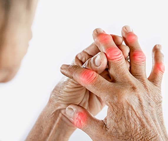 Physical therapy for arthritis and joint pain