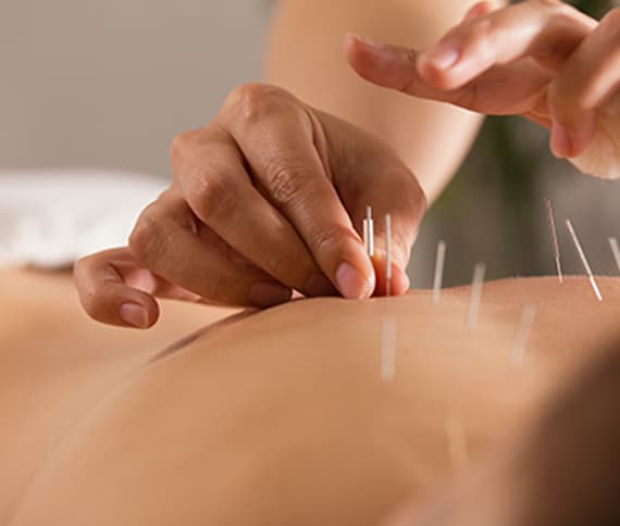 Dry needling treatment in Winchester, VA