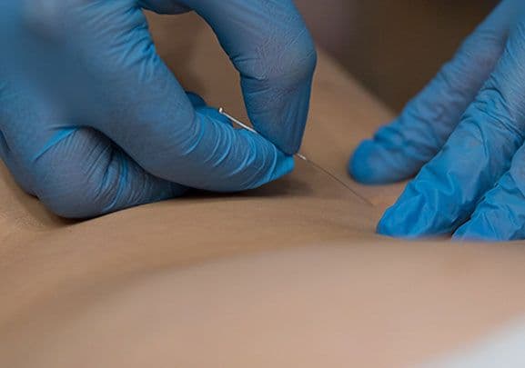Dry needling for joint pain treatment